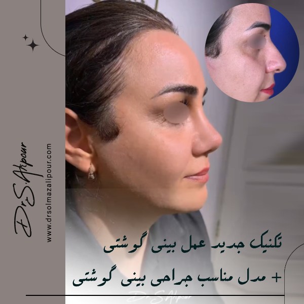 عکس عمل بینی گوشتی قبل و بعد