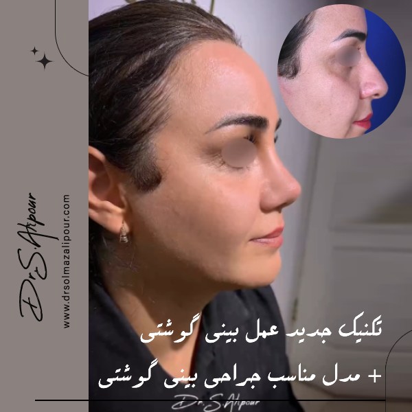 تکنیک جدید عمل بینی گوشتی + مدل مناسب جراحی بینی گوشتی