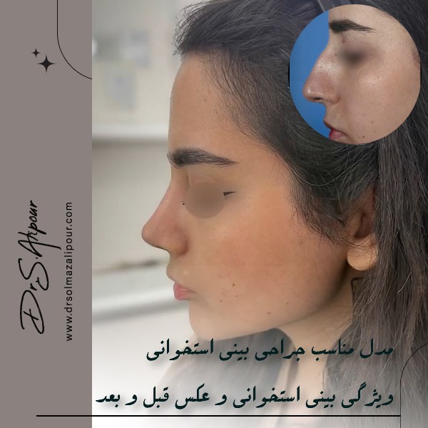 عکس عمل بینی استخوانی قبل و بعد