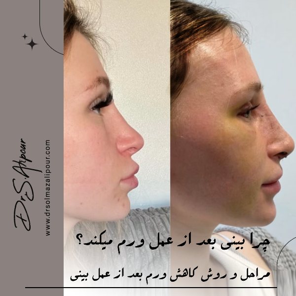 چرا بینی بعد از عمل ورم میکند؟ مراحل و روش کاهش ورم بعد از عمل بینی
