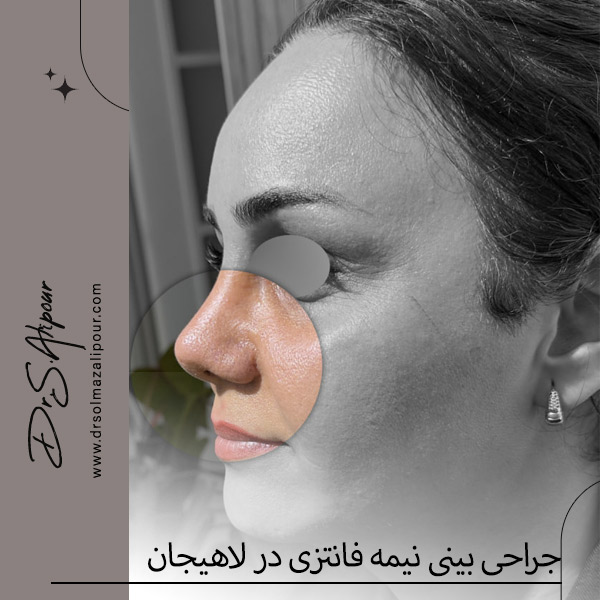 جراحی بینی نیمه فانتزی در لاهیجان - دکتر علیپور