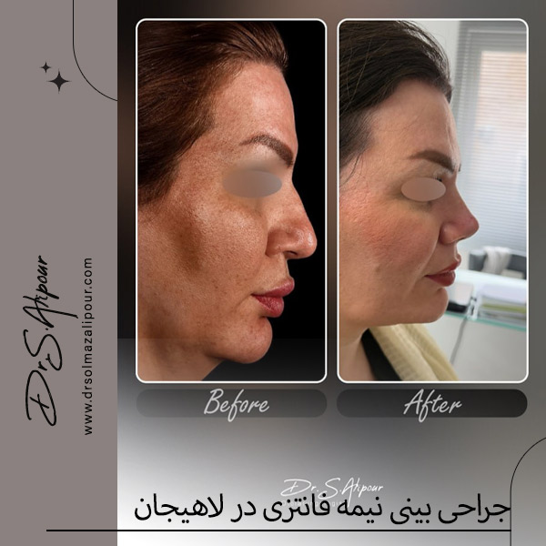 جراحی بینی نیمه فانتزی - دکتر علیپور