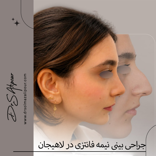 جراحی بینی نیمه فانتزی در لاهیجان - دکتر علیپور