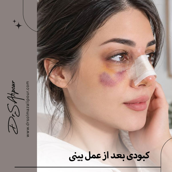 کبودی بعد از عمل بینی + دکتر سولماز علیپور